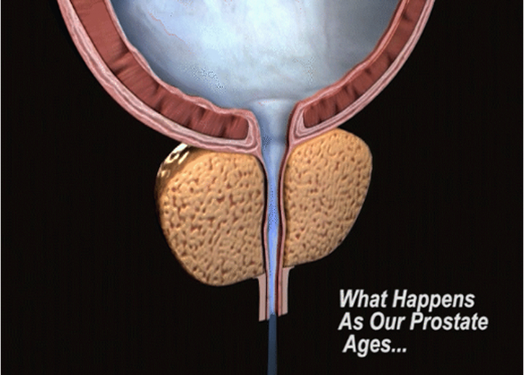 What happens as our prostate ages...